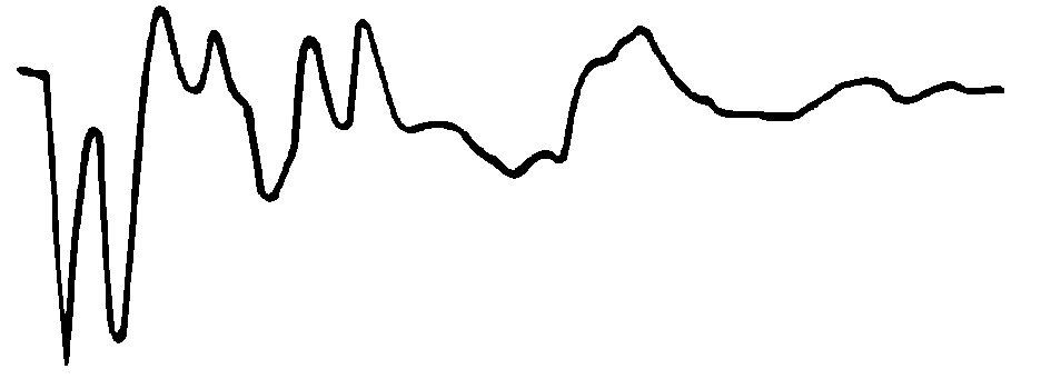 無遠端短路環(huán)波形 無遠端短路環(huán)波形